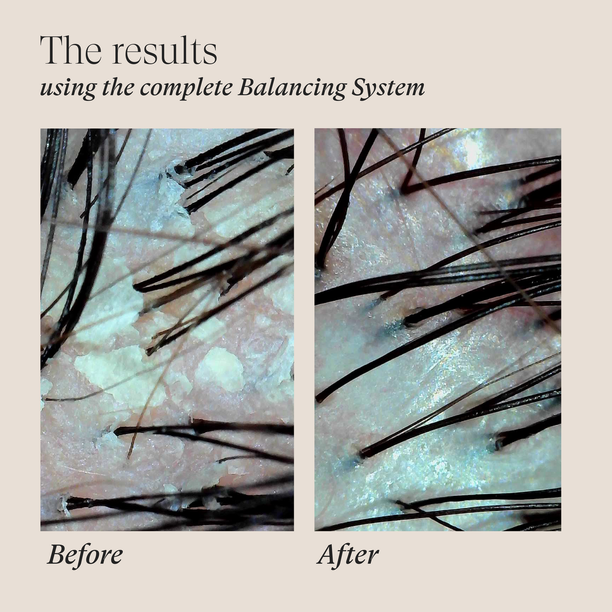 LNZ Scalp Therapy Balancing System 2026
